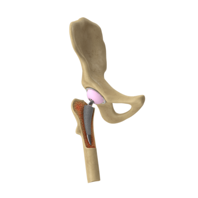 Modelo de una prótesis de cadera
