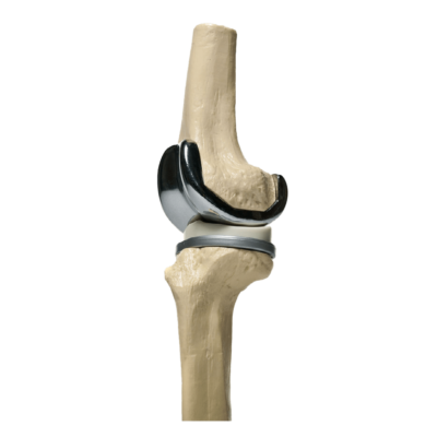 Modelo de una prótesis de rodilla