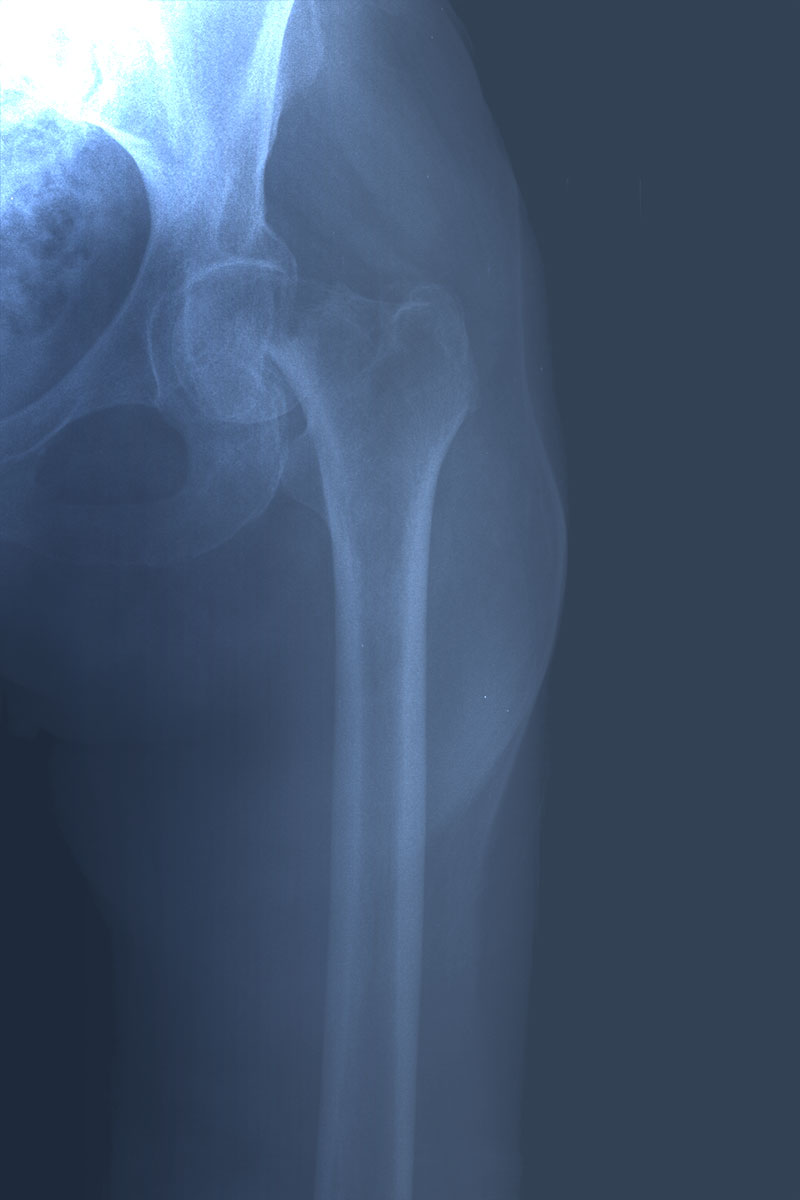 Fractura del cuello del fémur. Paciente candidata a prótesis.
