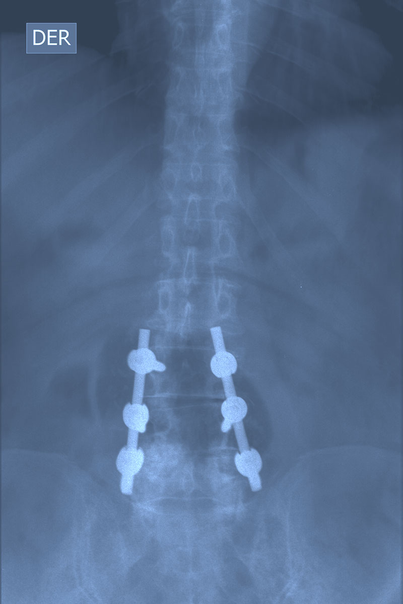 Radiografía post quirúrgica. Instrumentación y descompresión lumbar