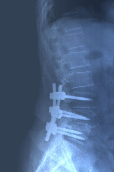 Radiografía post quirúrgica. Instrumentación y descompresión lumbar.