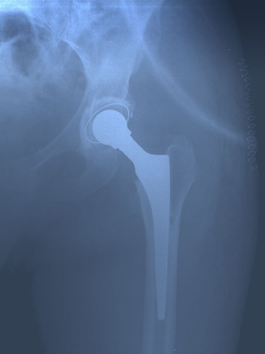 Radiografía Prótesis de Cadera cemetada. Día post quirúrgico.