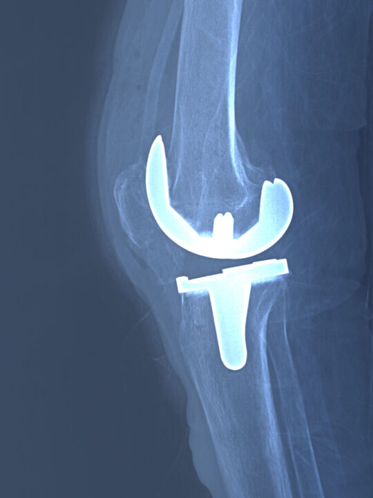 Radiografía de prótesis total de rodilla derecha