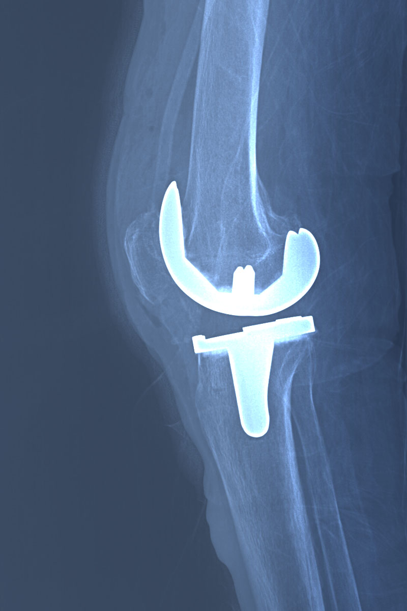 Radiografía de prótesis total de rodilla derecha