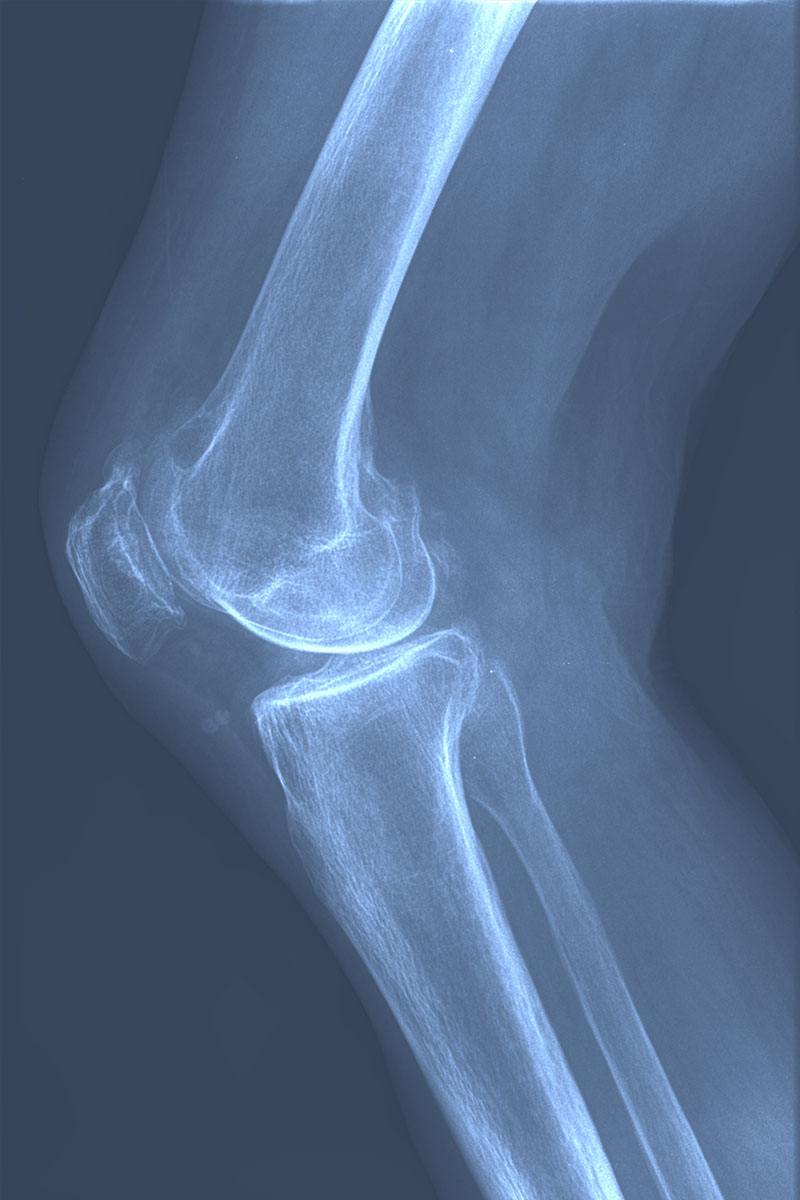 Radiografía lateral de una rodilla con desgaste en grado severo