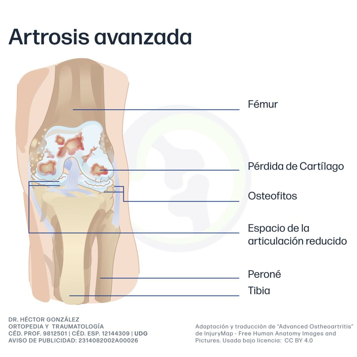 artrosis avanzada