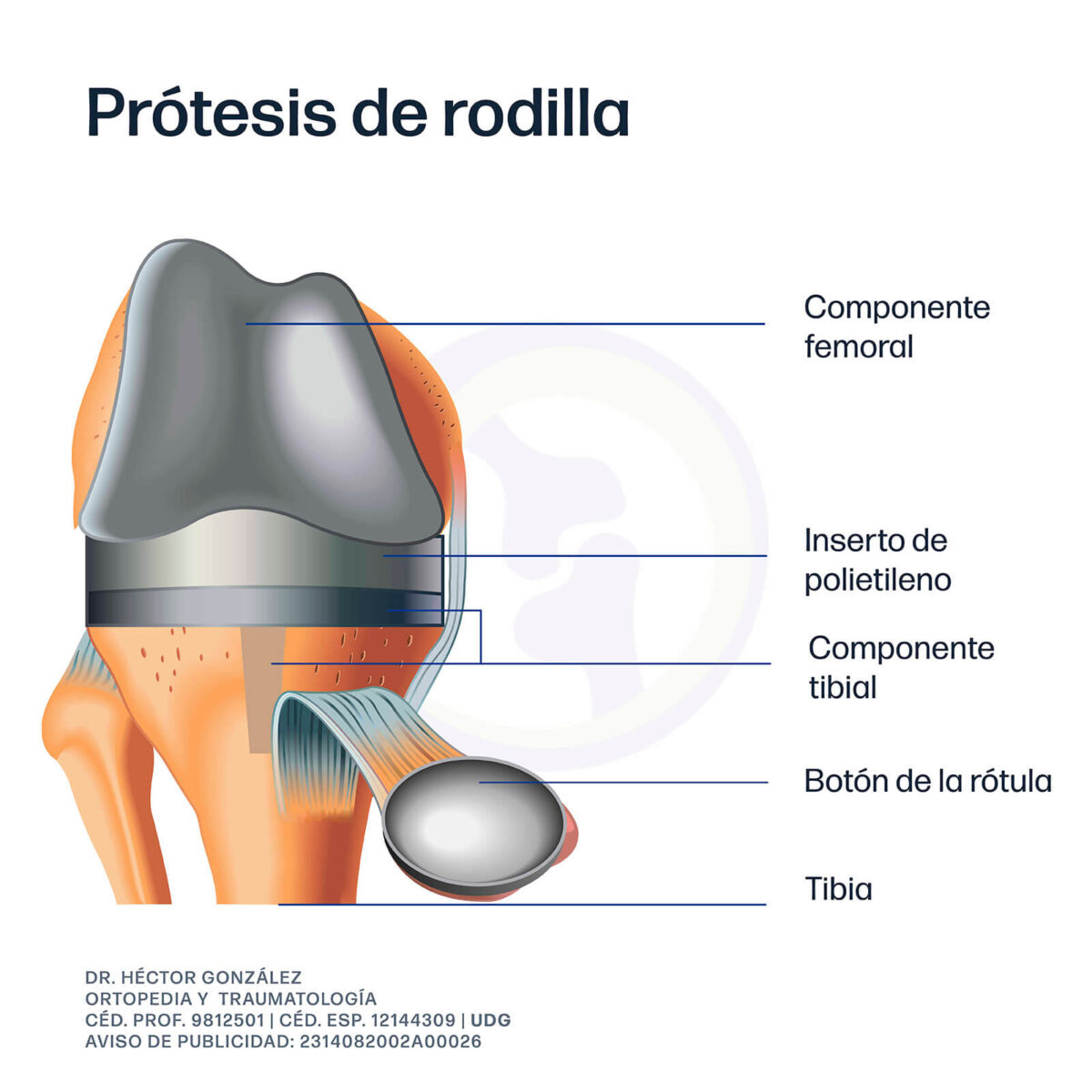 Componentes y materiales de la prótesis de rodilla
