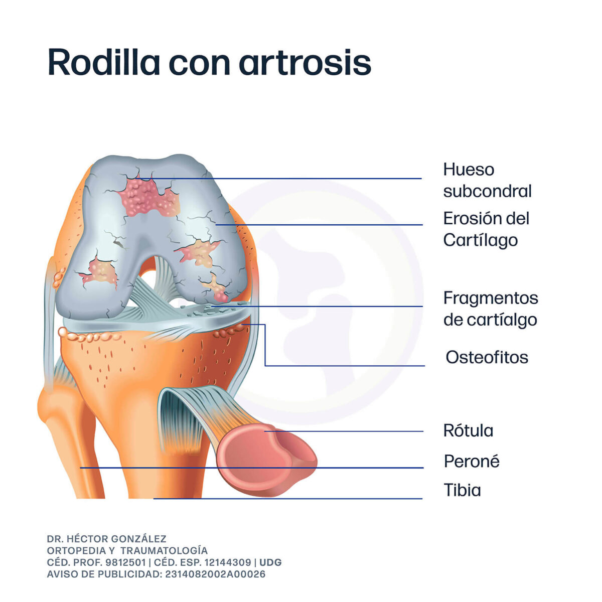 Rodilla con artrosis
