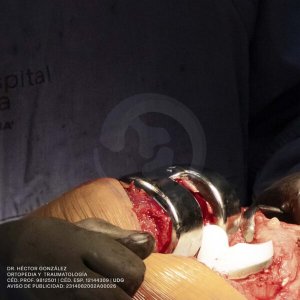 Colocación de prótesis de rodilla