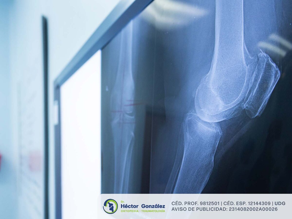 Cómo saber si necesito una cirugía de prótesis de rodilla