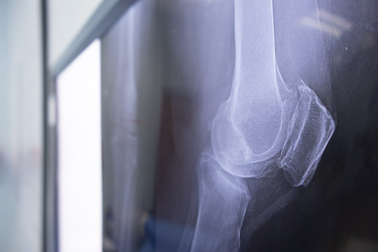 Radiografía de rodilla con gonartrosis