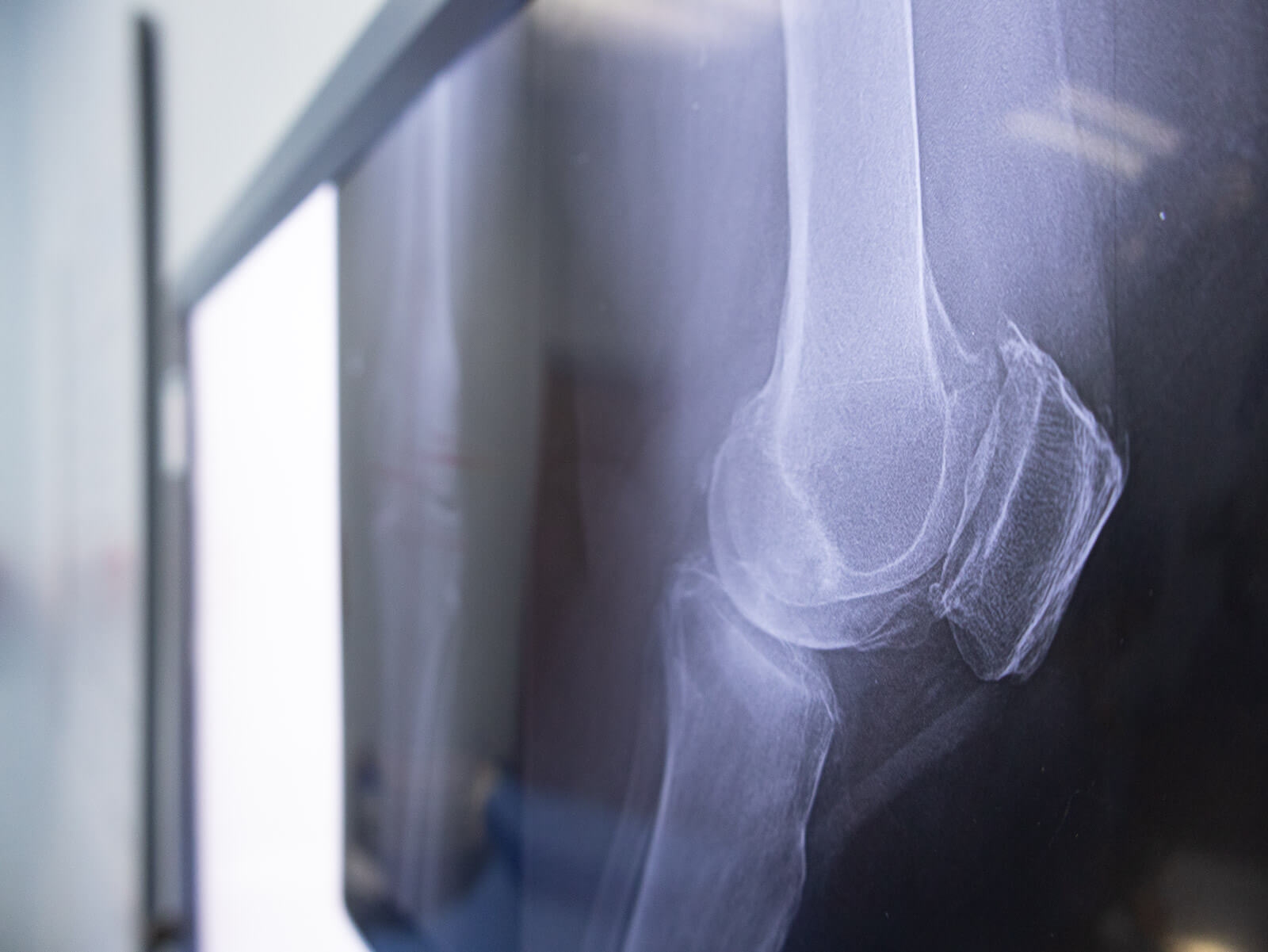 Radiografía de rodilla con gonartrosis